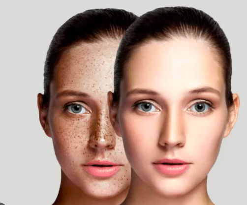 Understanding How Long Hyperpigmentation Takes to Fade Away How Long Hyperpigmentation Takes to Fade Away