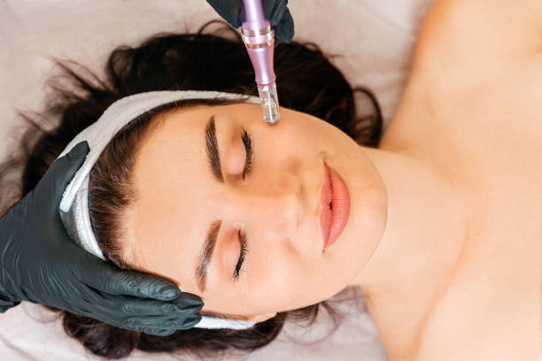 How Often Should You Get Microneedling? Find Out Here! How Often Should You Get Microneedling